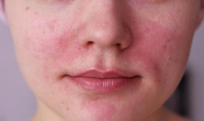 Červená tvář, červené skvrny (tečky) na kůži obličeje u dítěte, u dospělého - příčiny, diagnostika a léčba, foto